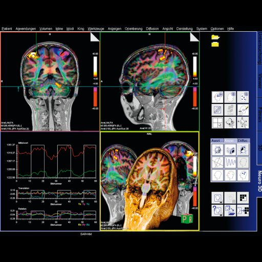 MRI ELBOW JOINT PLANNING AND POSITIONING ON PHILIPS 3T 